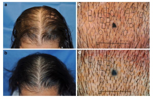 ヘアマックスのレーザーで毛が生えてきてきた研究結果の画像